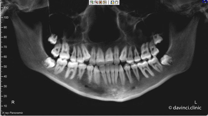 Ортопантомограмма для планирования ортодонтического лечения