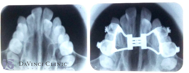 рентгеновский снимок верхней челюсти до и после лечения аппаратом Хааса