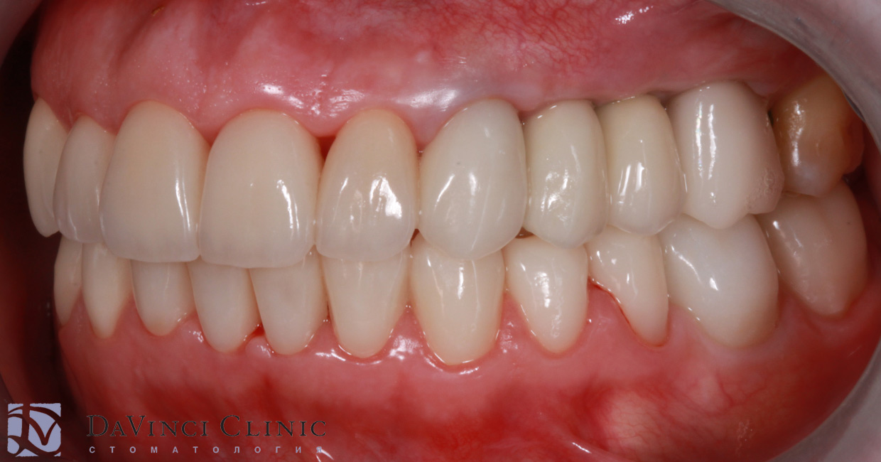 Вид слева после протезирования зубов керамикой