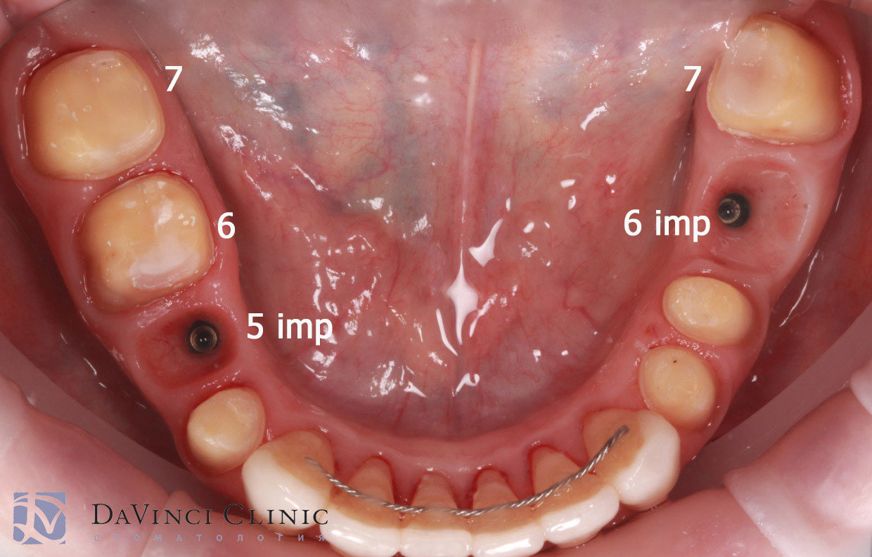 Ортодонтическая подготовка создала достаточно места для протезирования на имплантах