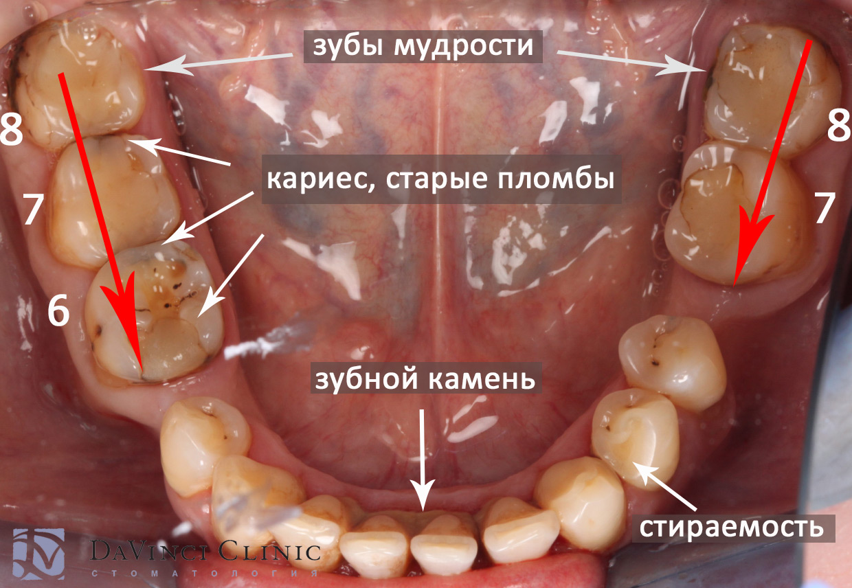 Нижние зубы до начала лечения