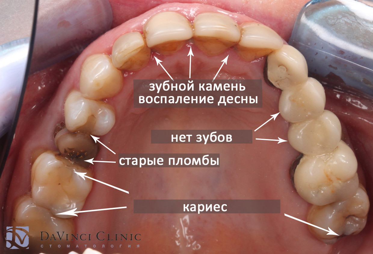 Верхние зубы до начала лечения