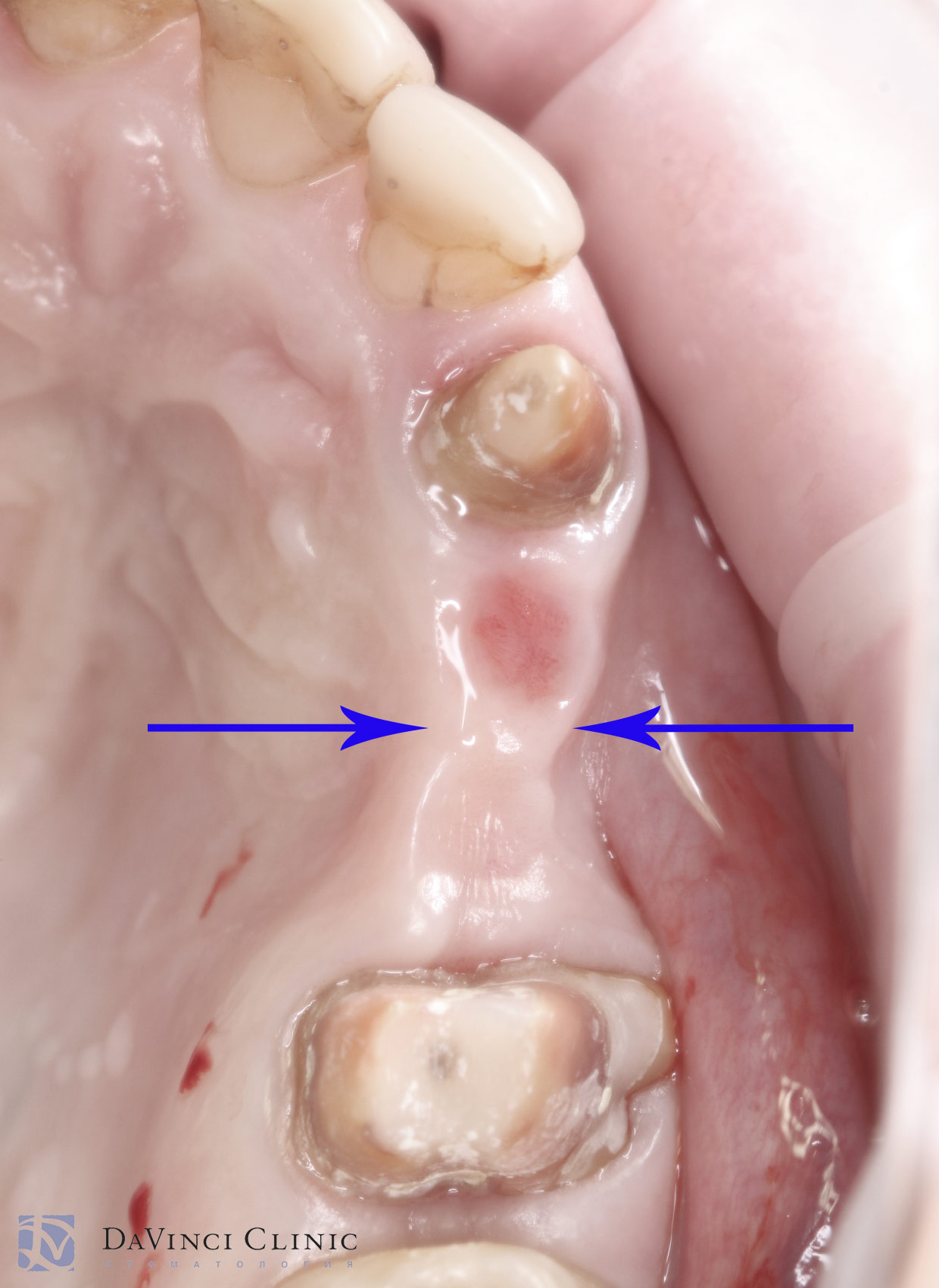 Недостаточная толщина кости в зоне имплантации верхних зубов