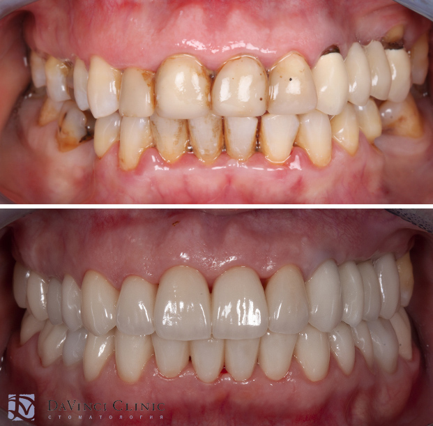 Имплантация зубов с ортодонтической подготовкой и тотальное протезирование зубов керамикой
