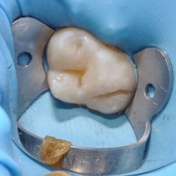 Лечение фиссурного кариеса седьмого зуба
